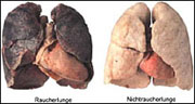 Raucherlunge